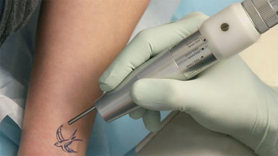 Benefits of Laser Tattoo Removal: Reach out to a dermatologist in  VASUNDHARA to Find out!