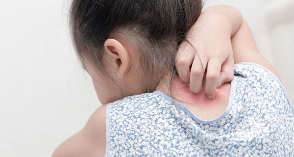 How To Deal With Psoriasis In Children?