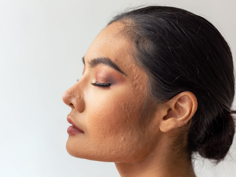 How to Get Rid of Large Pores and How to Treat Them - A Skin Specialist's Guide